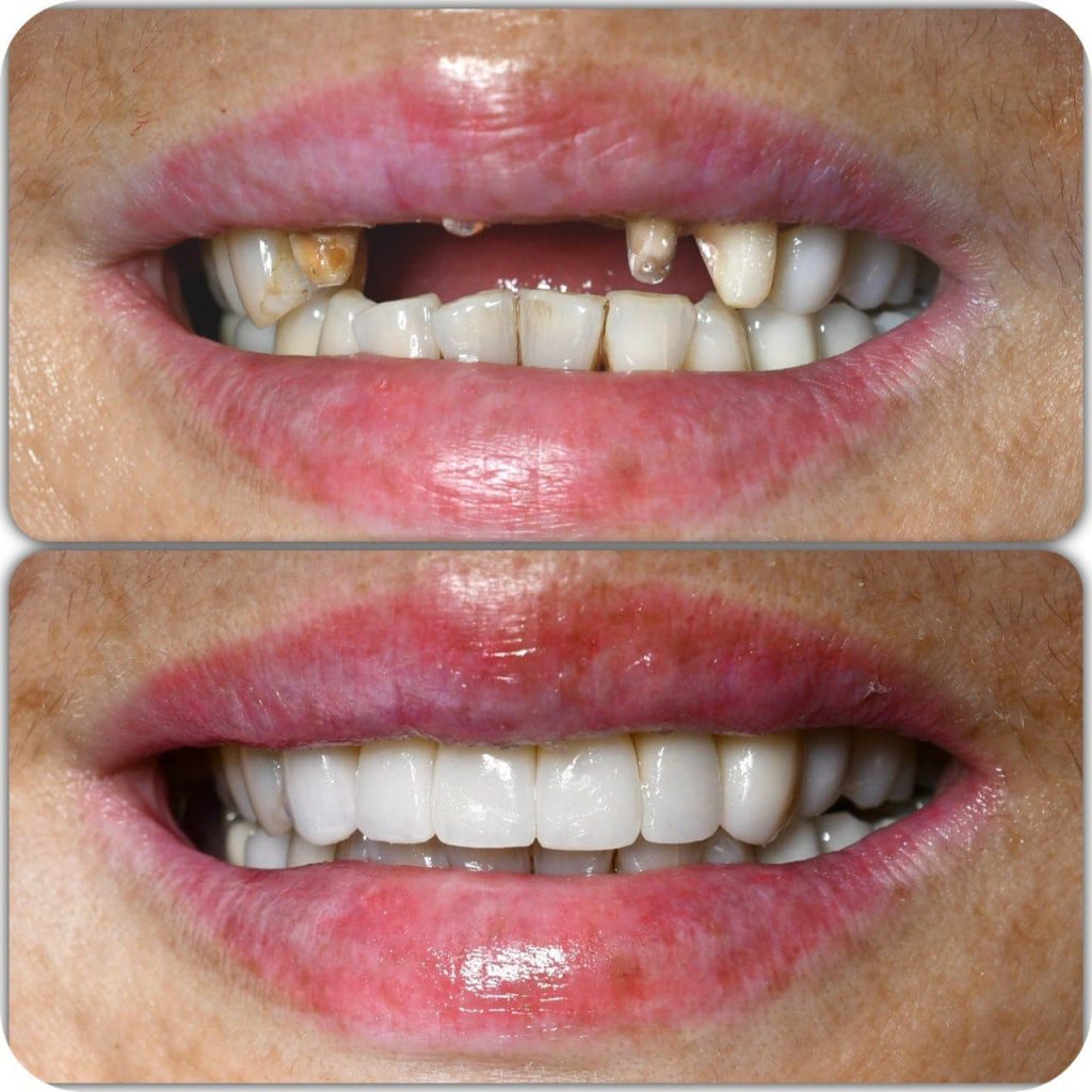 before and after implants