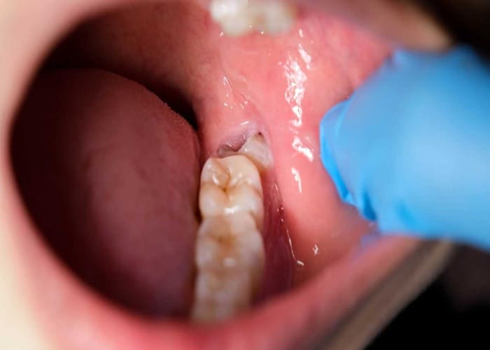an Impacted Wisdom Tooth