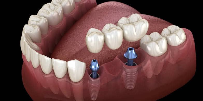 dental bridge