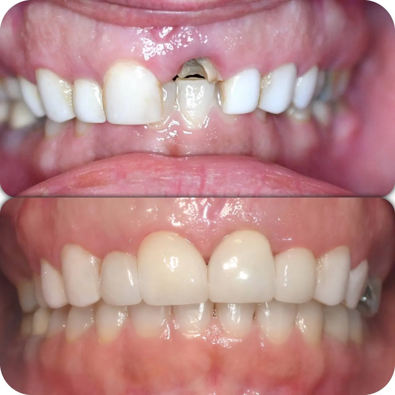 Dental implant restoration before and after at Langley Dental Group