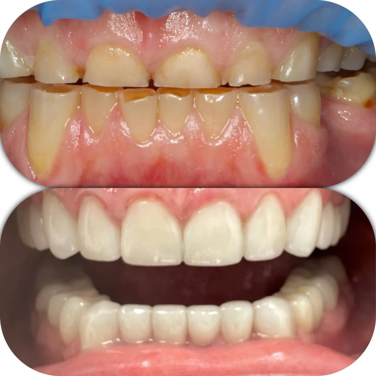 Full-mouth rehabilitation before and after at Langley Dental Group