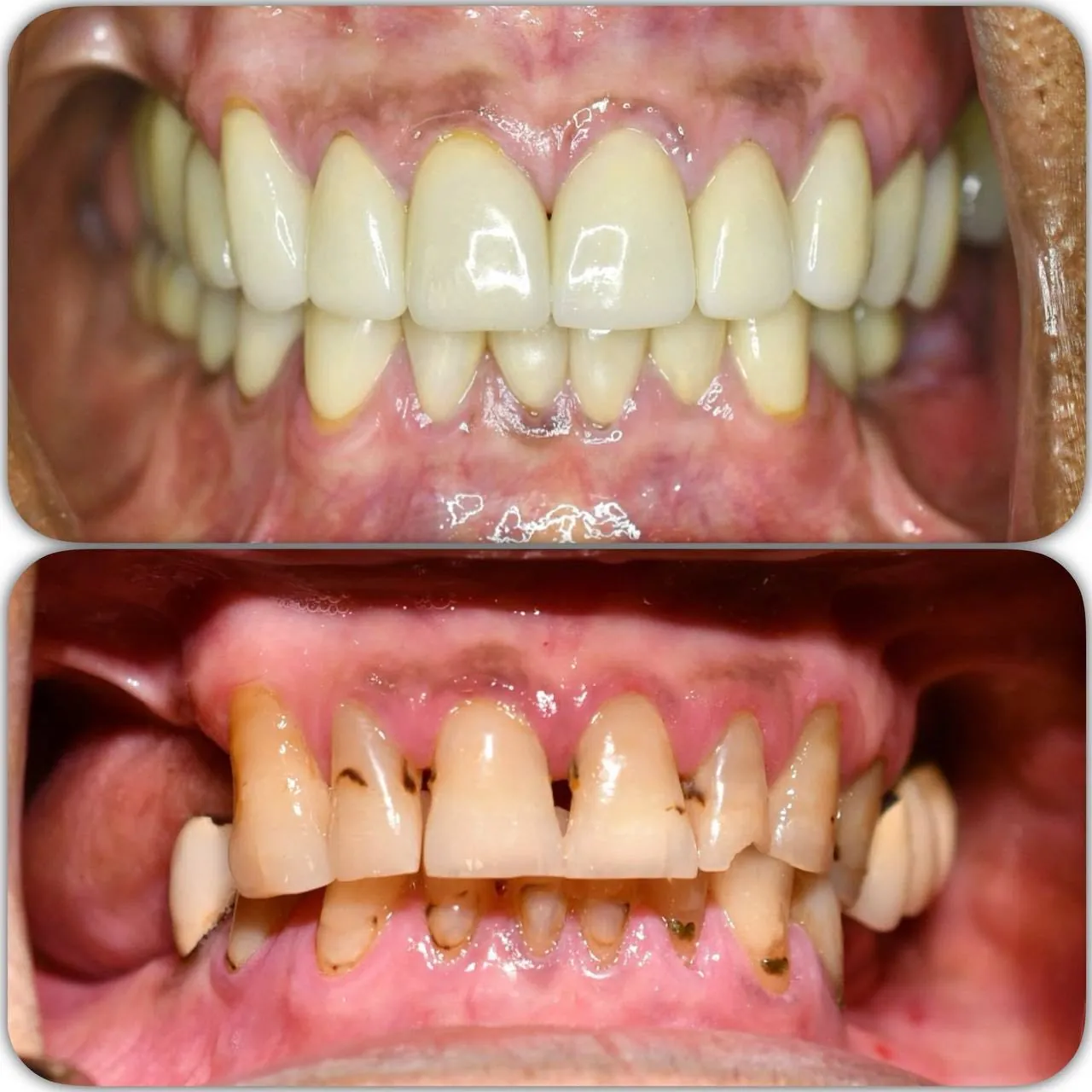 Gum and restorative dental treatment case in Langley