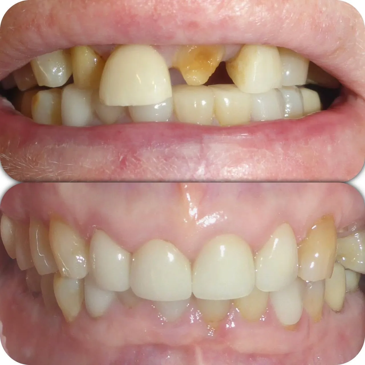 Front tooth implant restoration before and after in Langley
