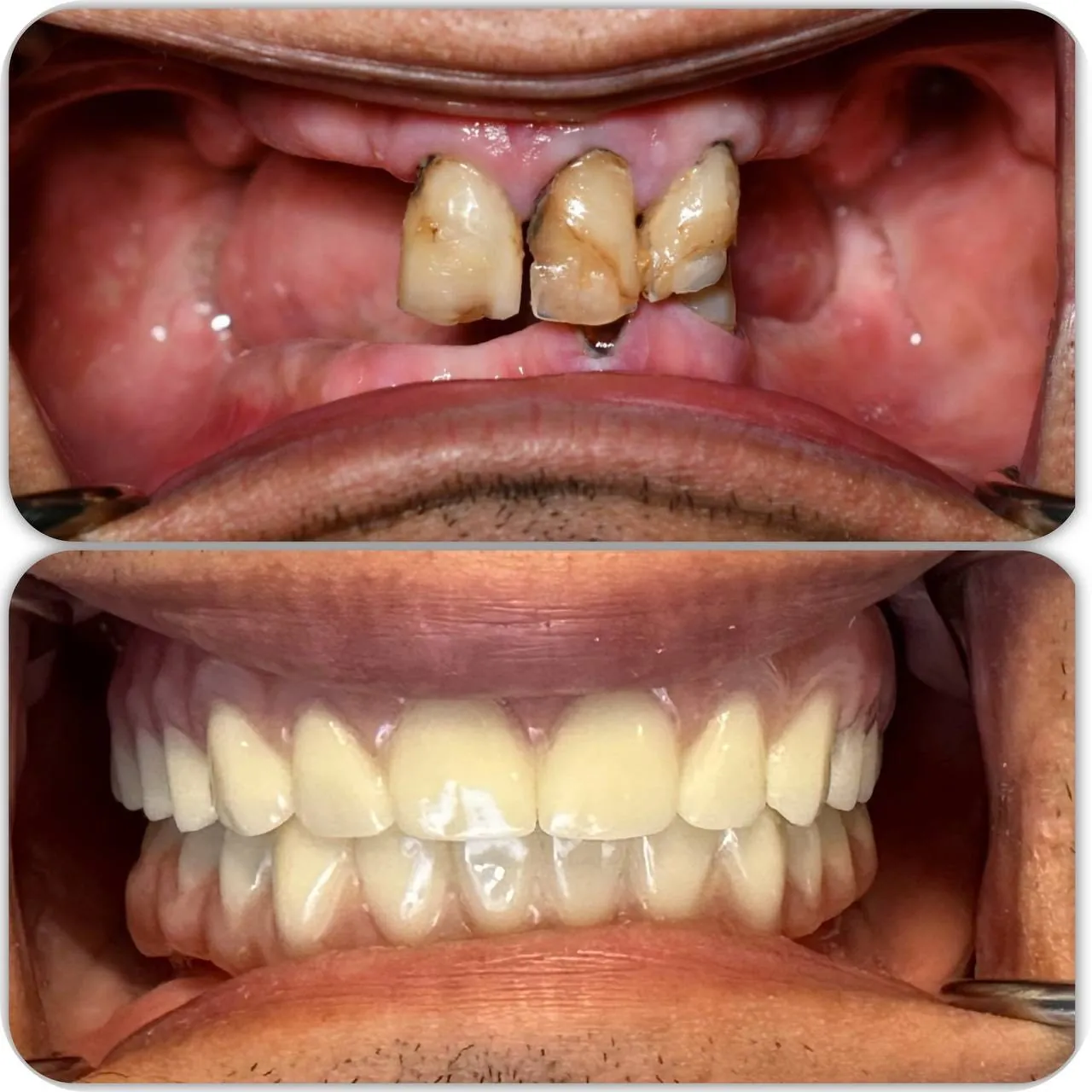Complex full-mouth reconstruction before and after in Langley