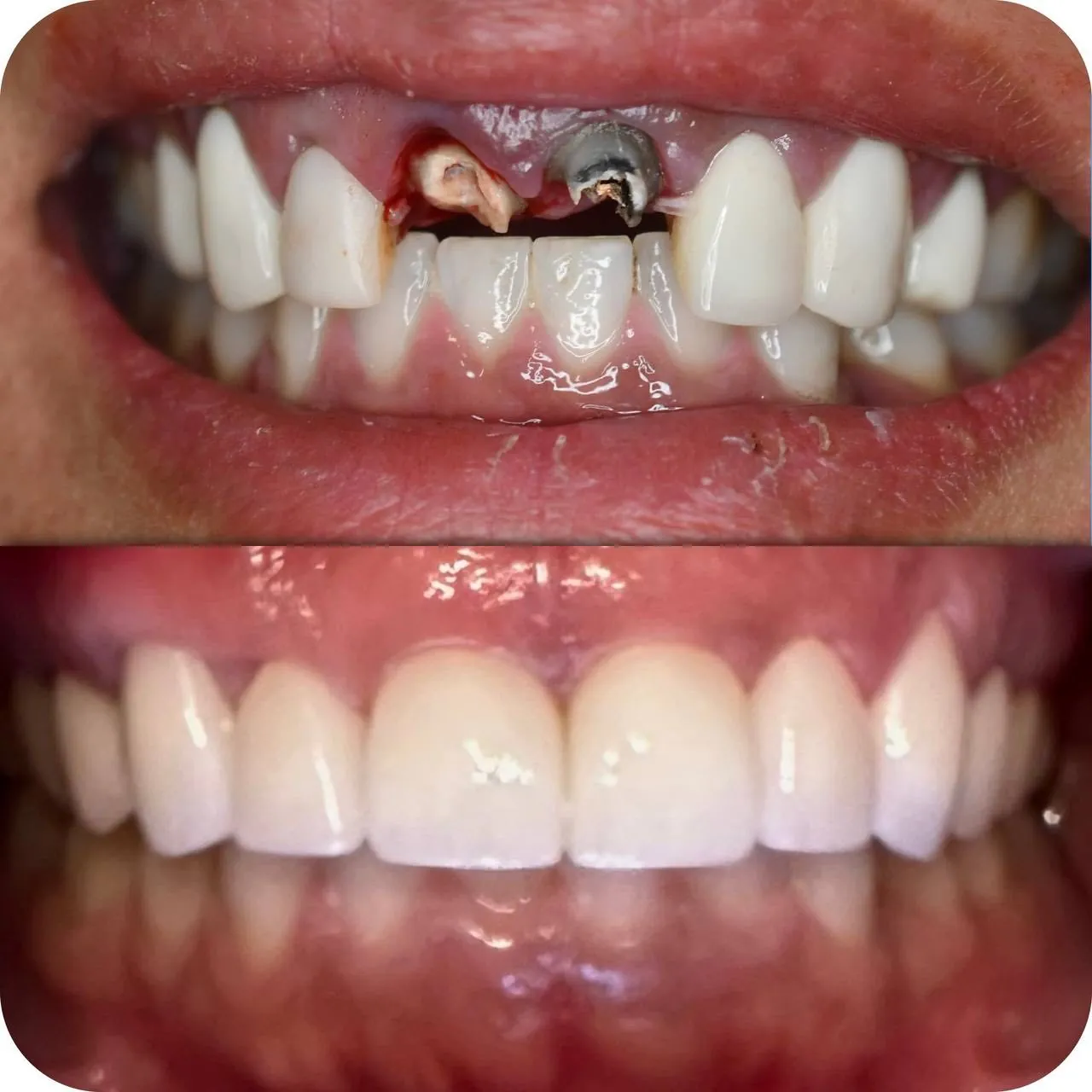 Damaged front teeth restored with crowns in Langley