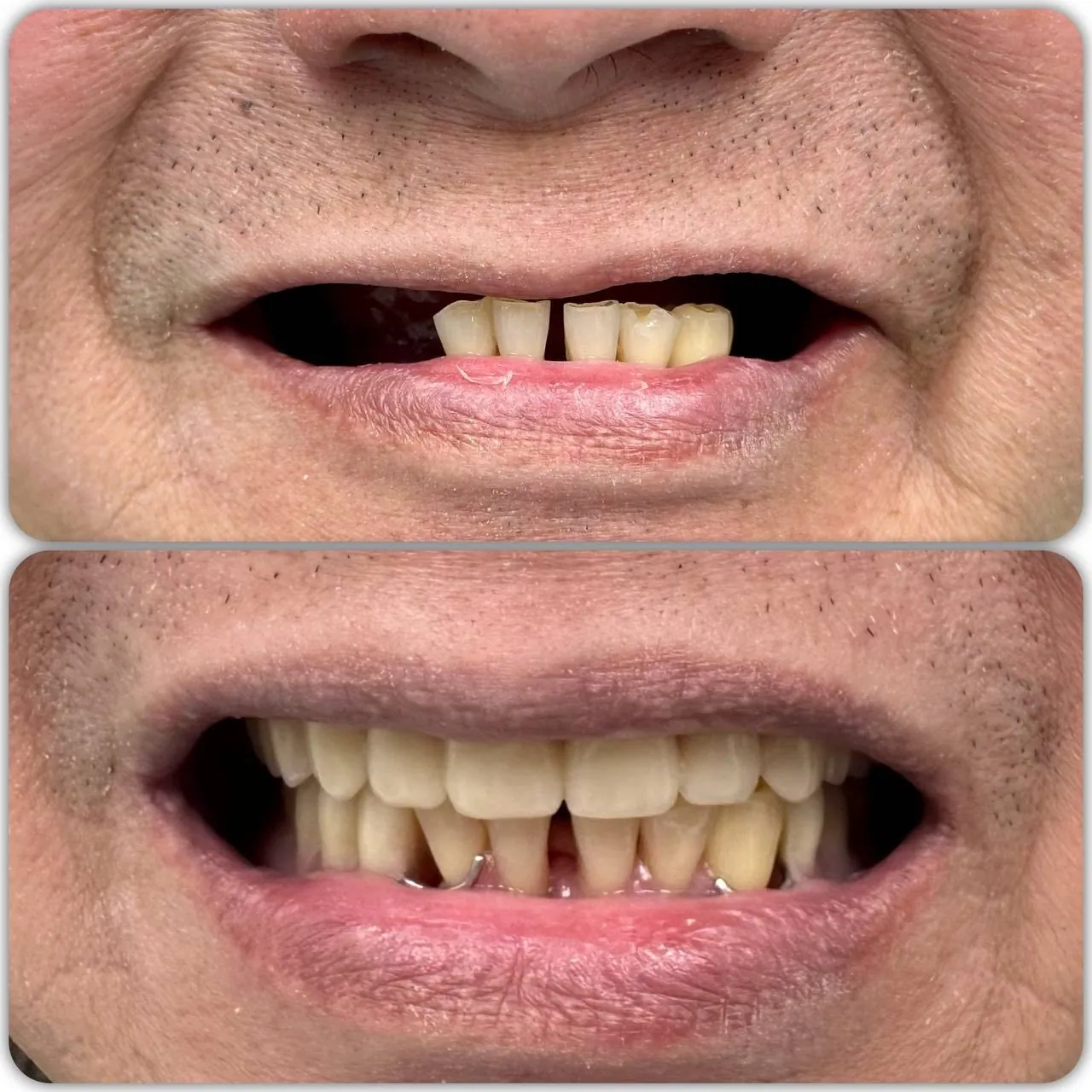 Missing front teeth restored with a denture in Langley