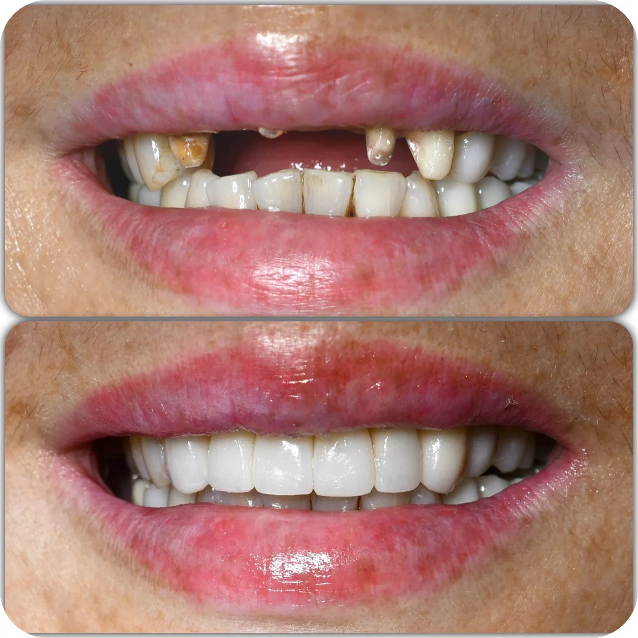 Dentures and missing teeth restoration before and after in Langley