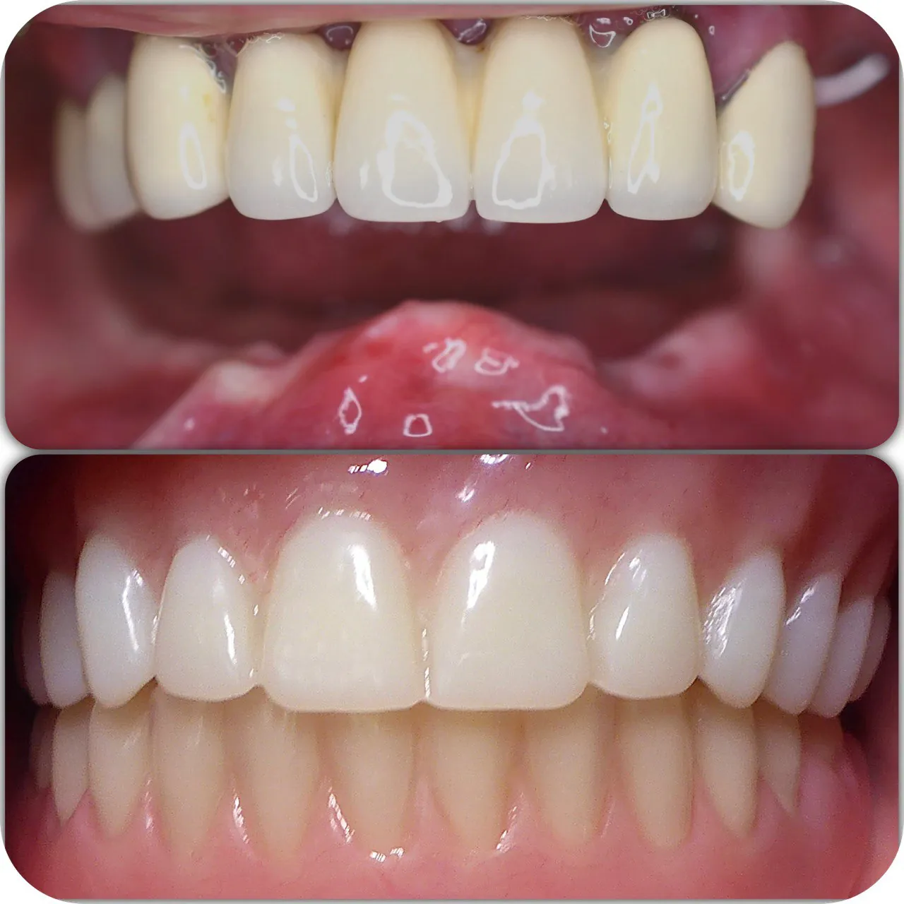 Anterior dental restoration before and after at Langley Dental Group