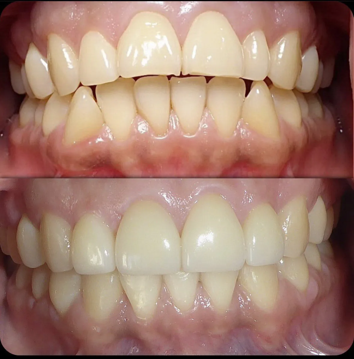 Veneers and cosmetic dentistry result in Langley