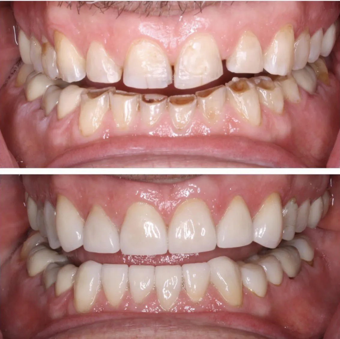 Smile transformation before and after at Langley Dental Group