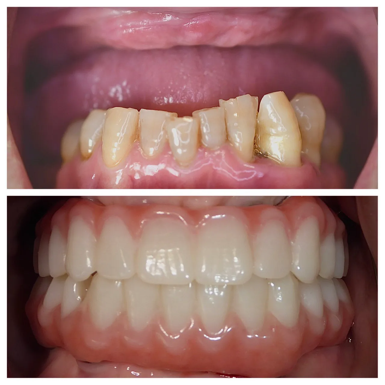 Full-mouth reconstruction before and after at Langley Dental Group