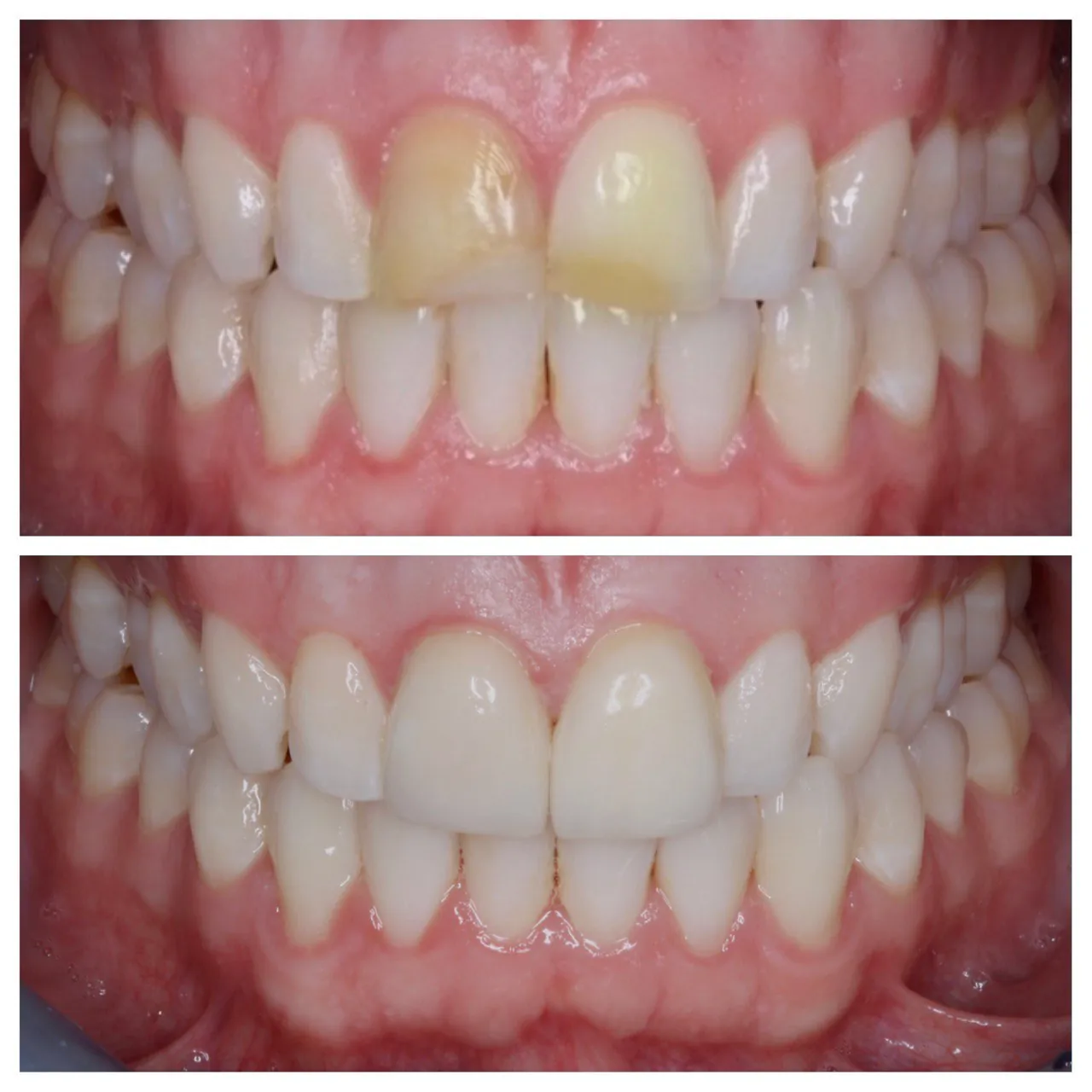 Smile makeover with veneers before and after in Langley