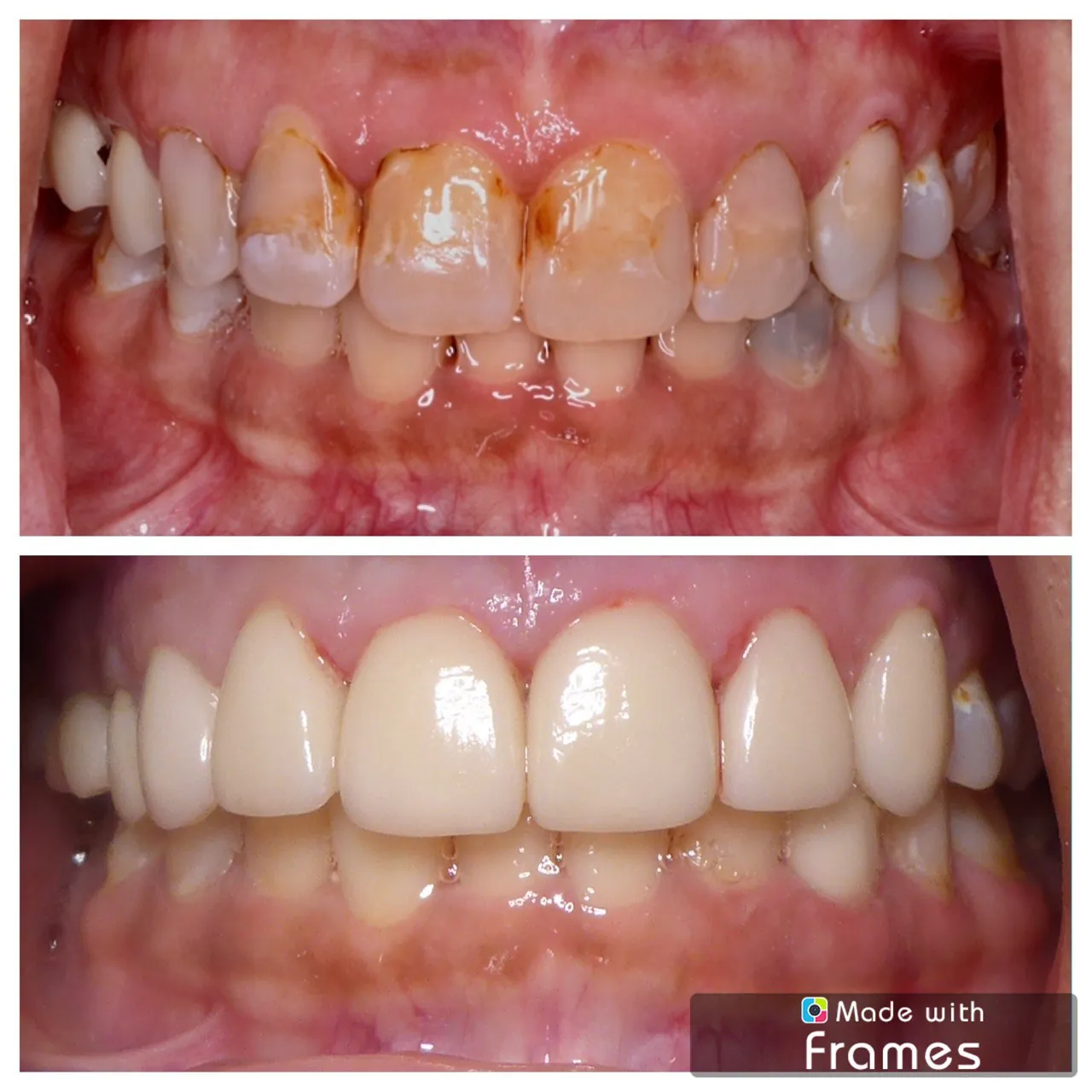 Dental crowns restoration before and after at Langley Dental Group