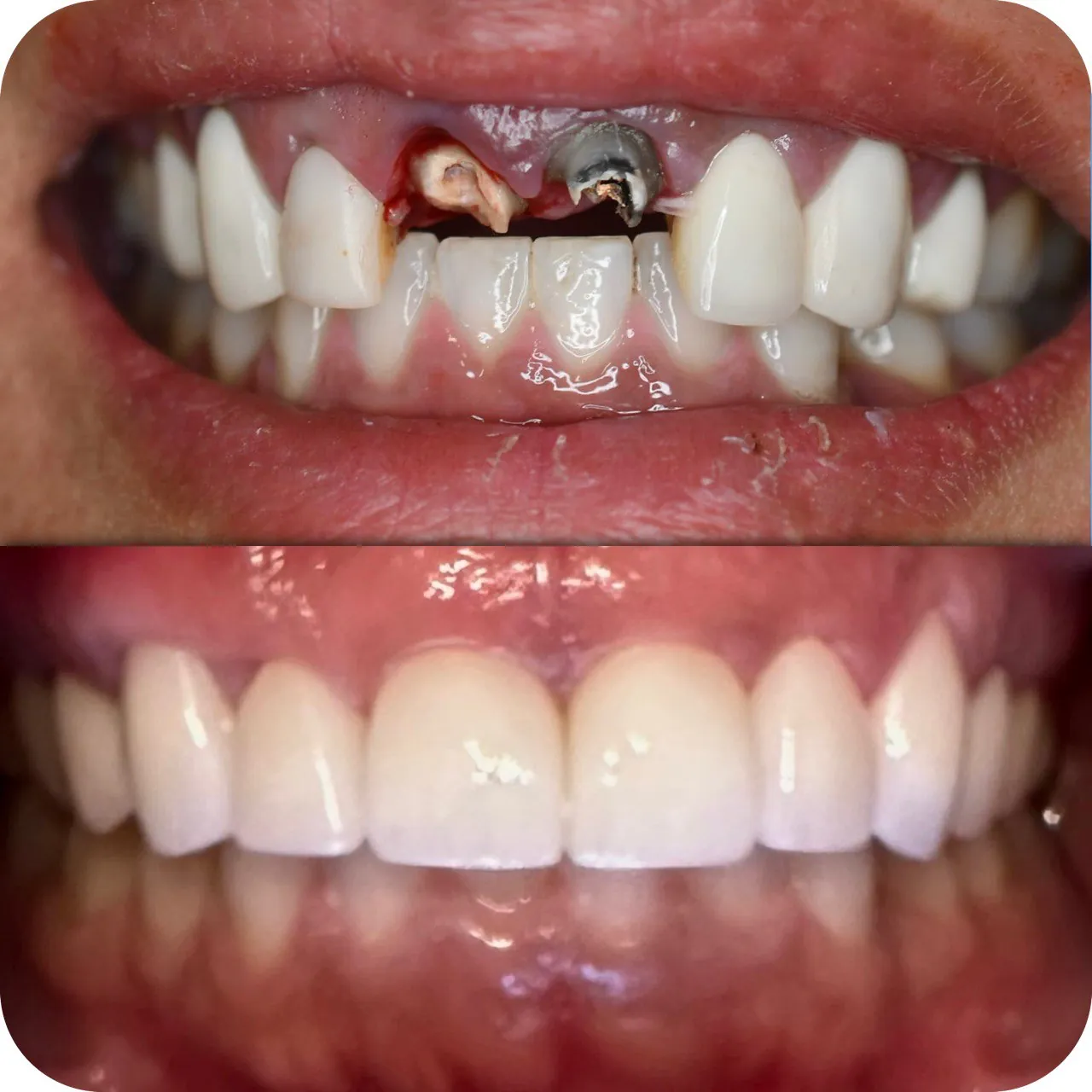 Front tooth crowns before and after in Langley