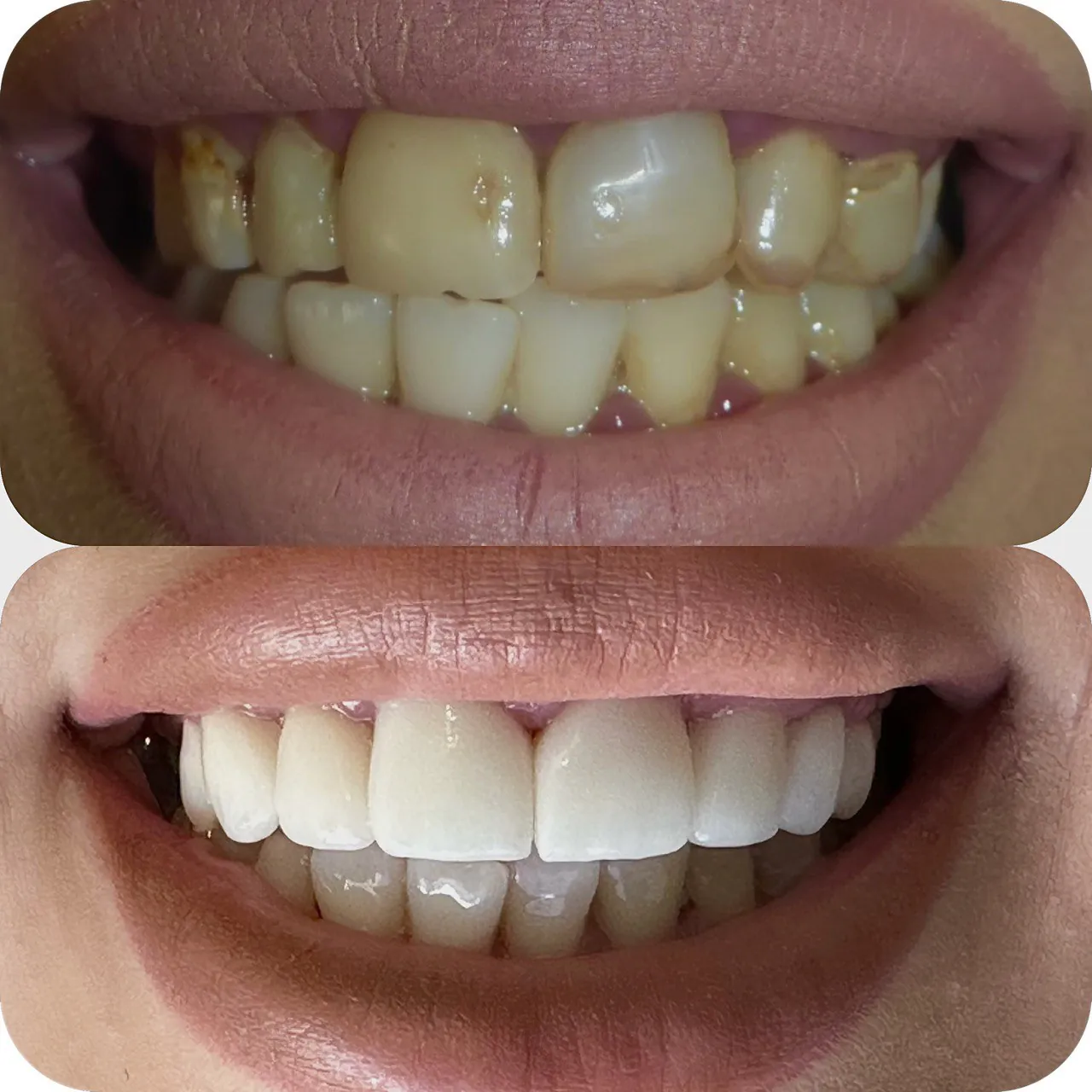 Cosmetic smile makeover before and after at Langley Dental Group