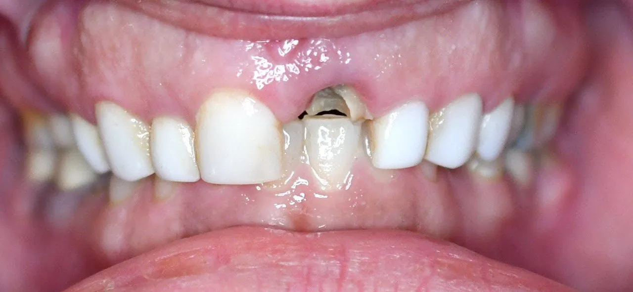 Single-tooth implant case at Langley Dental Group
