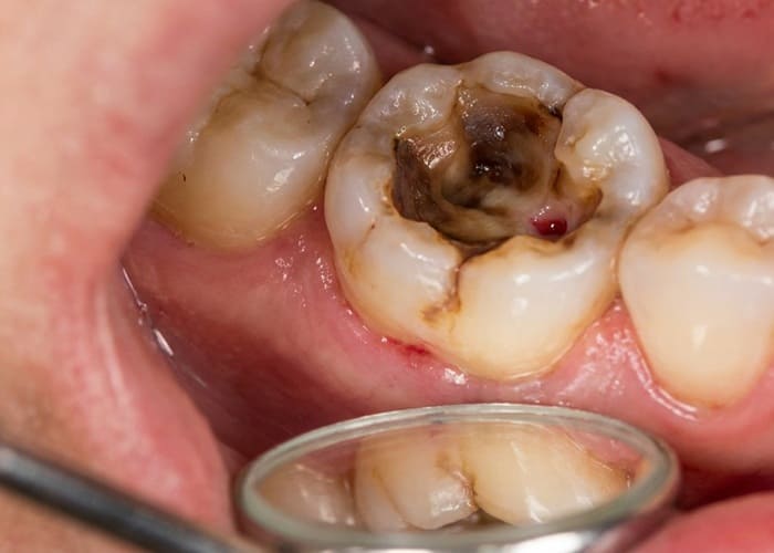 Tooth Decay Reaching the Nerve