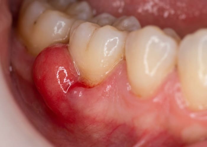 Tooth Infection and Abscess Formation Due to Decay