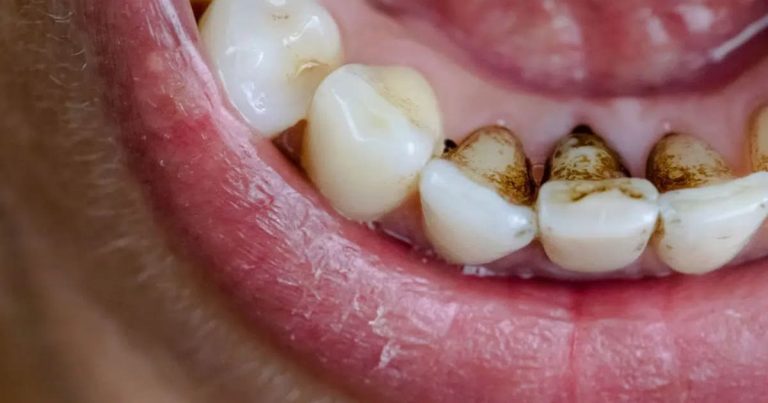What Happens If You Ignore Tooth Decay?