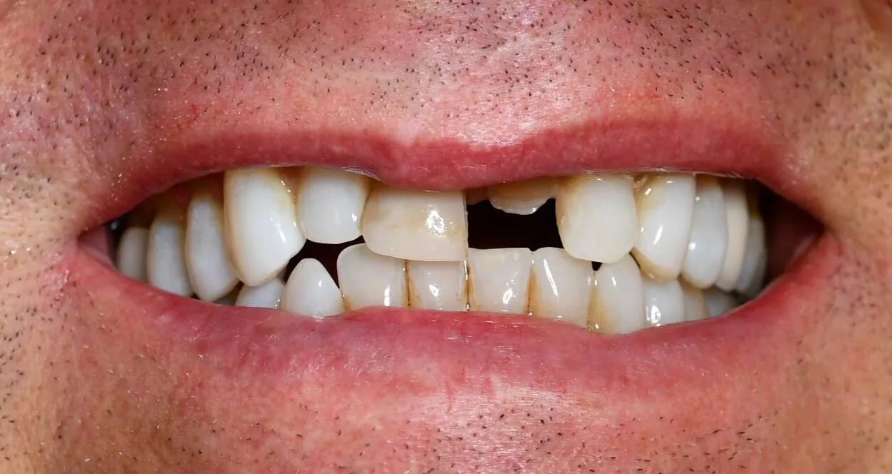 Restorative dental case before treatment at Langley Dental Group
