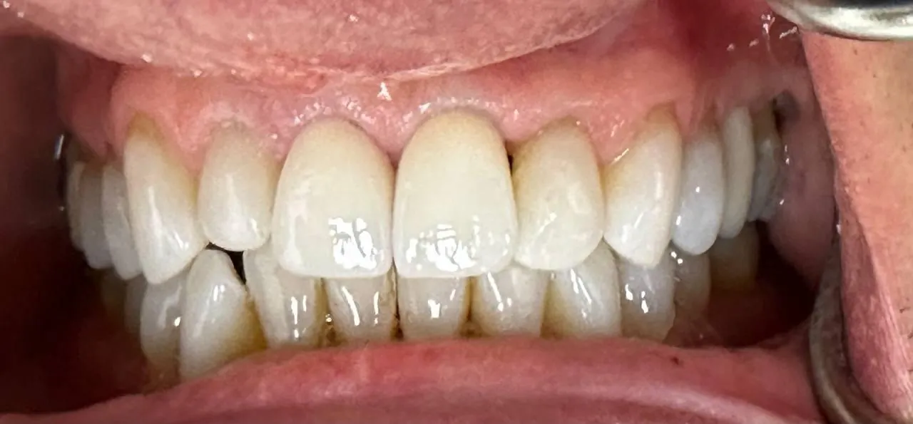 Restored upper teeth with dental crowns in Langley