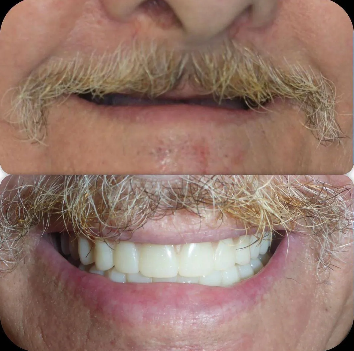 Denture smile transformation before and after in Langley