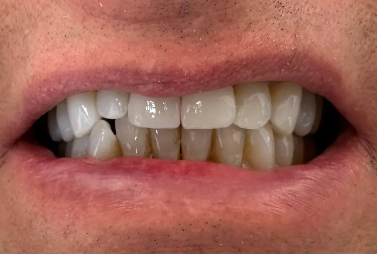 Full-mouth restorative dentistry result in Langley