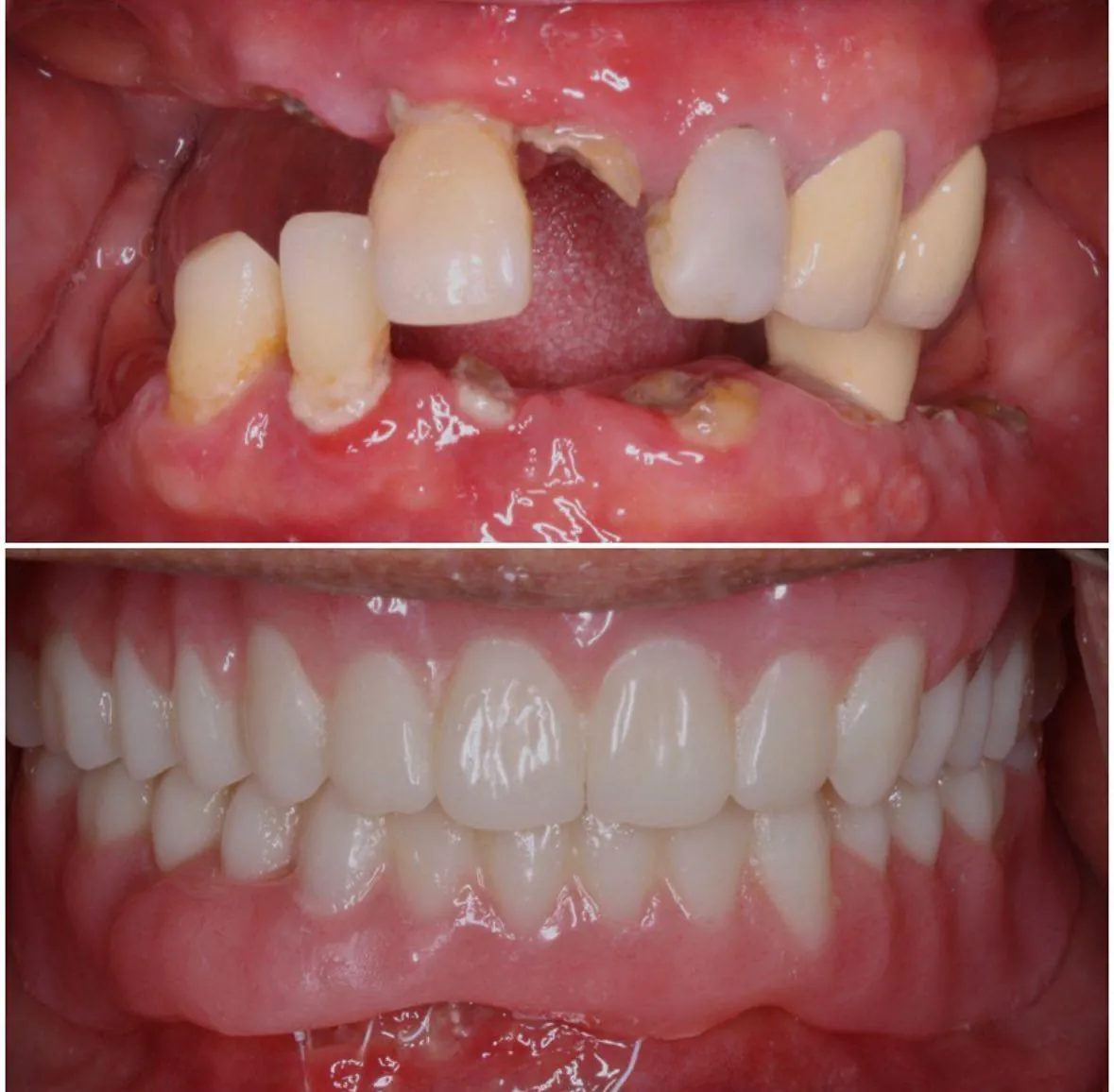 Complex denture rehabilitation before and after in Langley
