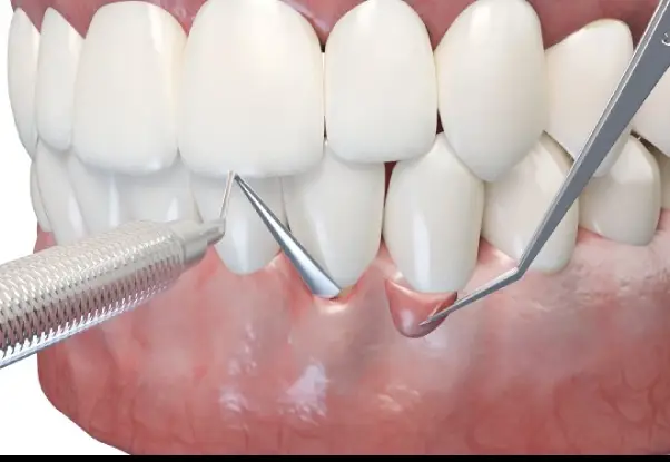 Gum Graft Treatment
