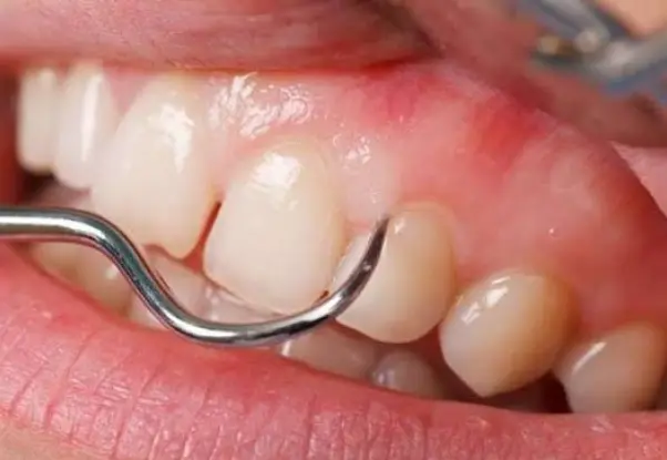 Periodontics langley