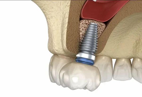 Sinus Lift