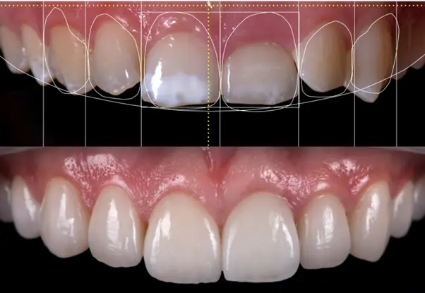 How Digital Smile Design Works